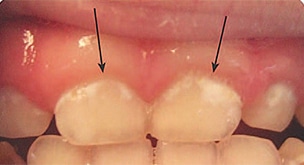 Early childhood dental caries white spots