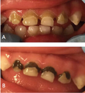 Arrested early childhood dental caries