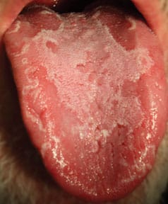 Burning mouth syndrome geographic tongue.