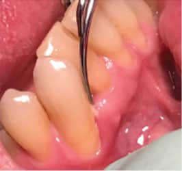 Periodontal maintenance