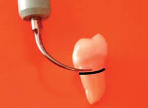 Tooth undergoing periodontal maintenance.