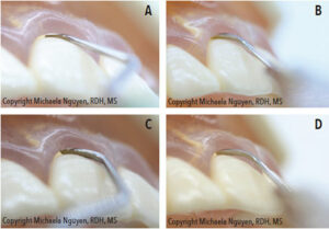 Accessing base of pocket, comparison of four types of instruments.