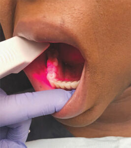 FIGURE 4.A close-up of an intraoral scan