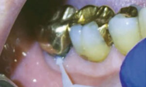 Tooth with silver diamine fluoride