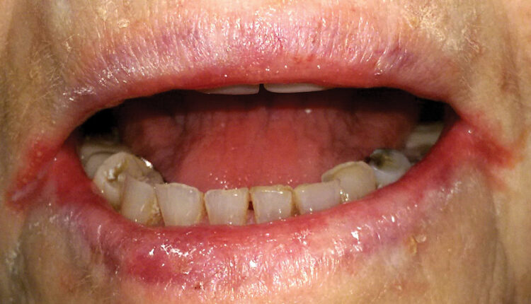 What is this red bump under my tongue? : r/DentalHygiene