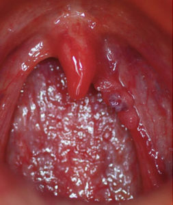 Warts caused by HPV