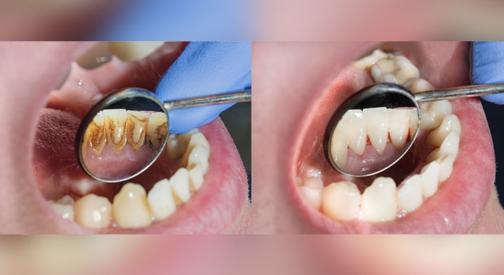 The Biology Behind Periodontal Disease Phenotypes