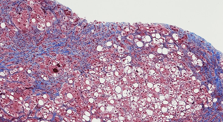 Cirrhosis of the liver with hepatic steatosis and chronic hepatitis