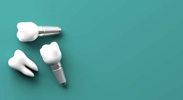 teeth implants