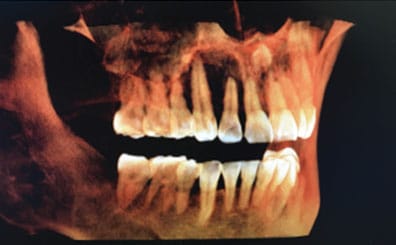 CBCT frontal view