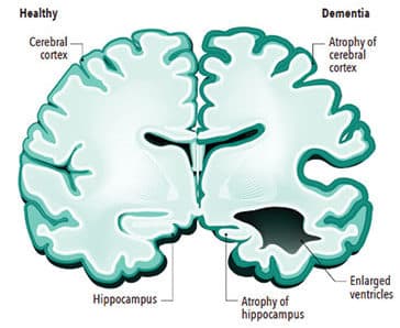 Brain affected by dementia