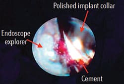 Use of dental endoscope on peri-implantitis