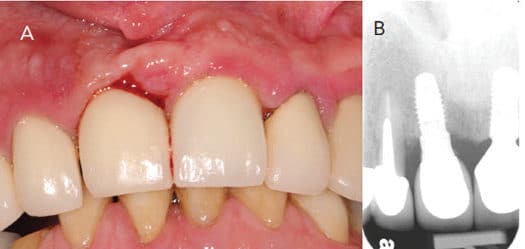 Bone loss on implant