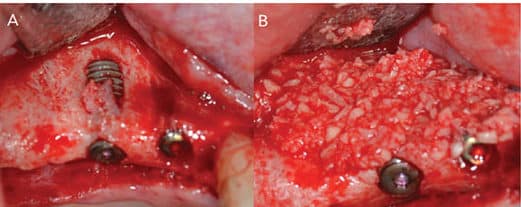 Dental implant therapy