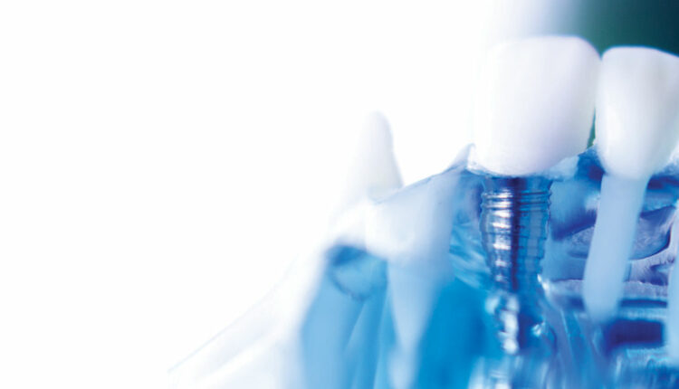 Implant therapy