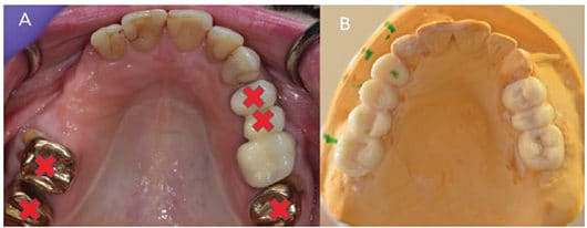 Implant placement