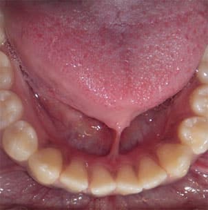 Patient with ankyloglossia