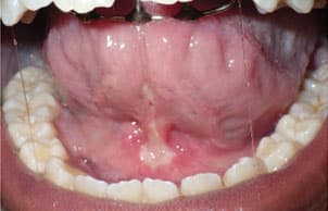 One week post-op following lingual frenectomy