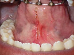 Post-op following lingual frenectomy