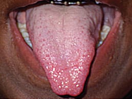 Mobility after lingual frenectomy