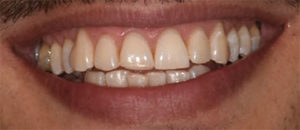 Outcome after tooth whitening