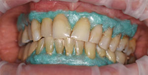 Sealing gingiva margins