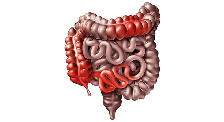 Crohn’s disease or crohn illness medical concept as human intestines with inflammation symptoms causing obstruction as a 3D illustration.