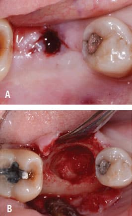 Implant removal site