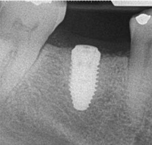 Radiograph of dental implant