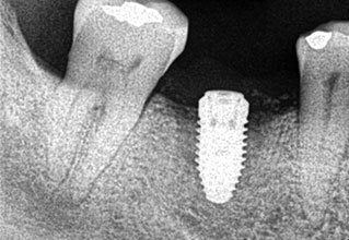 Peri-implant bone loss