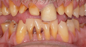 Dental erosion