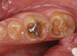 Sign of tooth wear