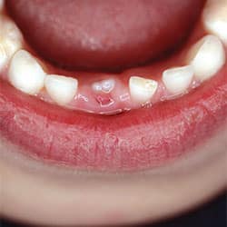 Baby teeth