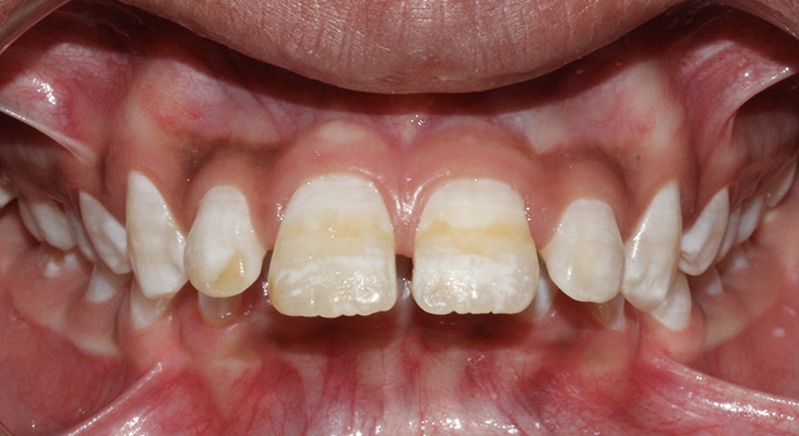 a child with forwardly placed upper teeth, proclination