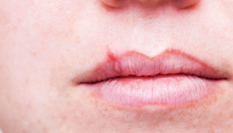 Lip deals herpes treatment