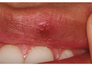 Person with herpes st post laser therapy treatment