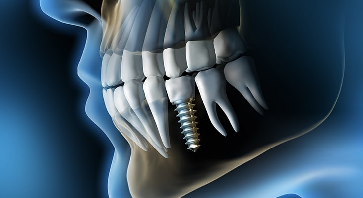 Medical Visualization - Dental Implant in the Jaw - 3D Rendering