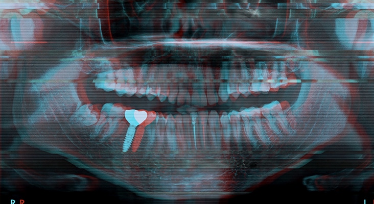 egative shot of digital picture with glitch effect. Panoramic black and white image dental x-ray of adult with single dental implant. Roentgen teeth upper and lower jaw.