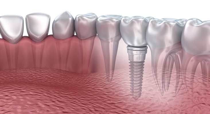 3D rendering : lower teeth and dental implant transparent render