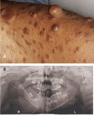 Images of neurofibromatosis