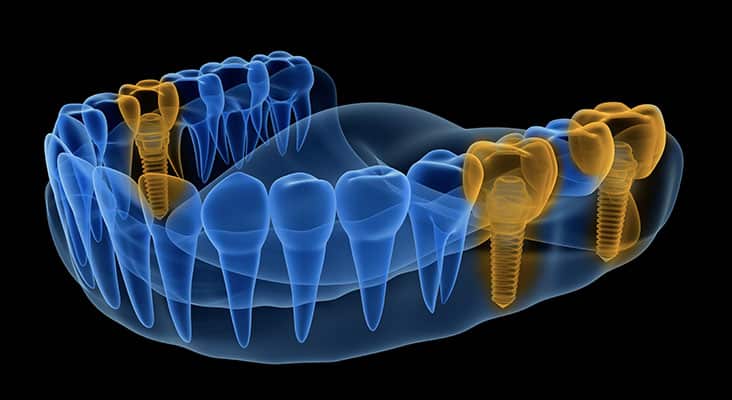 X-ray view of denture with implants . Xray view. Medically accurate 3D illustration