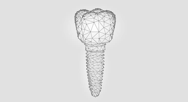 Molar tooth dental implant 3d low poly geometric model. Dentistry innovation future technology titan metal thread. Medical healthy science abstract gray white polygonal point line vector illustration