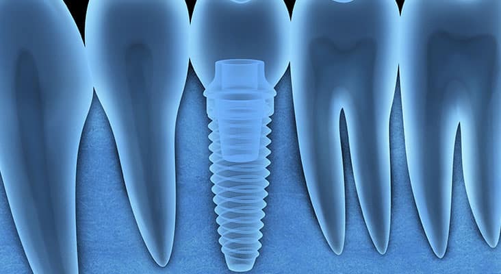 Tooth human implant x-ray (done in 3d, graphics)