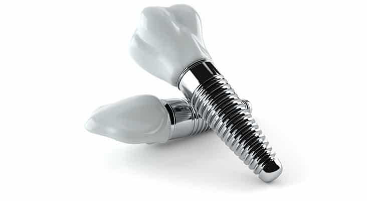 Dental implants isolated on white background