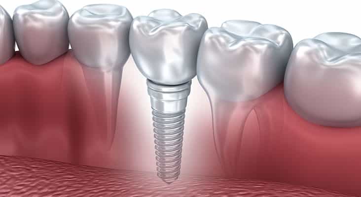 Tooth human implant, 3d illustration