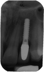 FIGURE 3. Progressive bone loss was seen on the facial and interproximal of this implant 15 years after the crown was cemented.