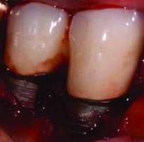 Facial implant
