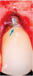 Progressive bone loss around the implant