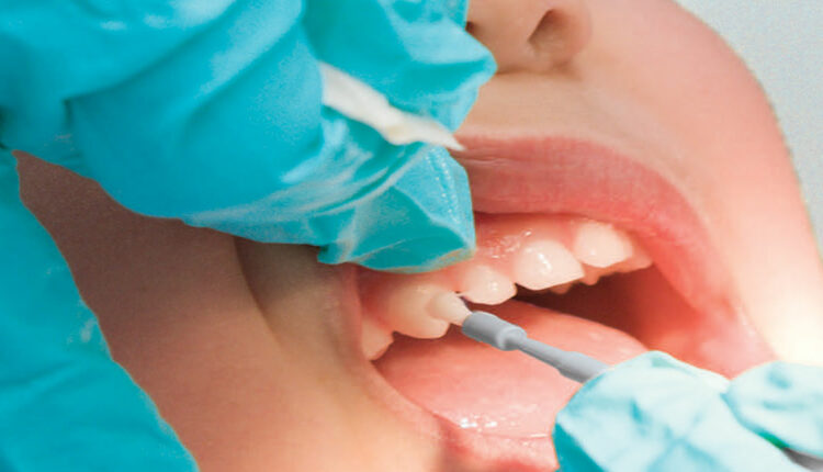 Clinician applying fluoride