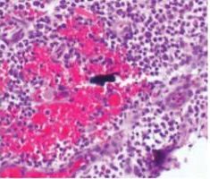 FIGURE 1. A fragment of titanium surrounded by inflammatory cells was found in the soft tissue around an implant with peri-implantitis.